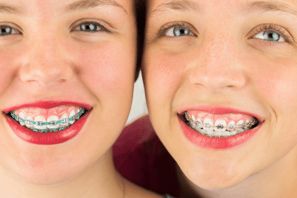 Close-up of teen girl smiling with metal braces | Troy City Orthodontics in Fall River, MA