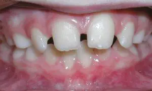 Close-up of white teeth with gap before treatment | Troy City Orthodontics in Fall River, MA