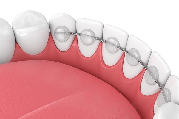 Dental model showing red gums and clear braces | Troy City Orthodontics in Fall River, MA